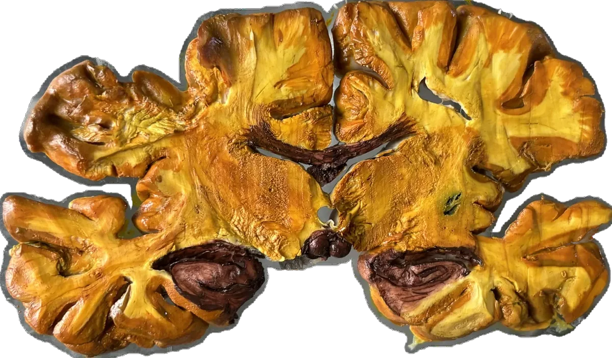 Alzheimer's brain