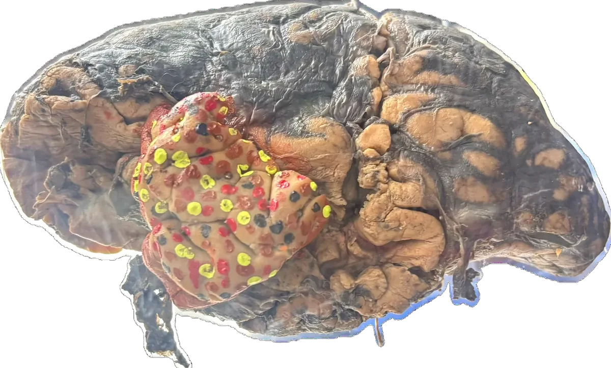 Astrocytoma - Involves Frontal & Temporal Lobes
