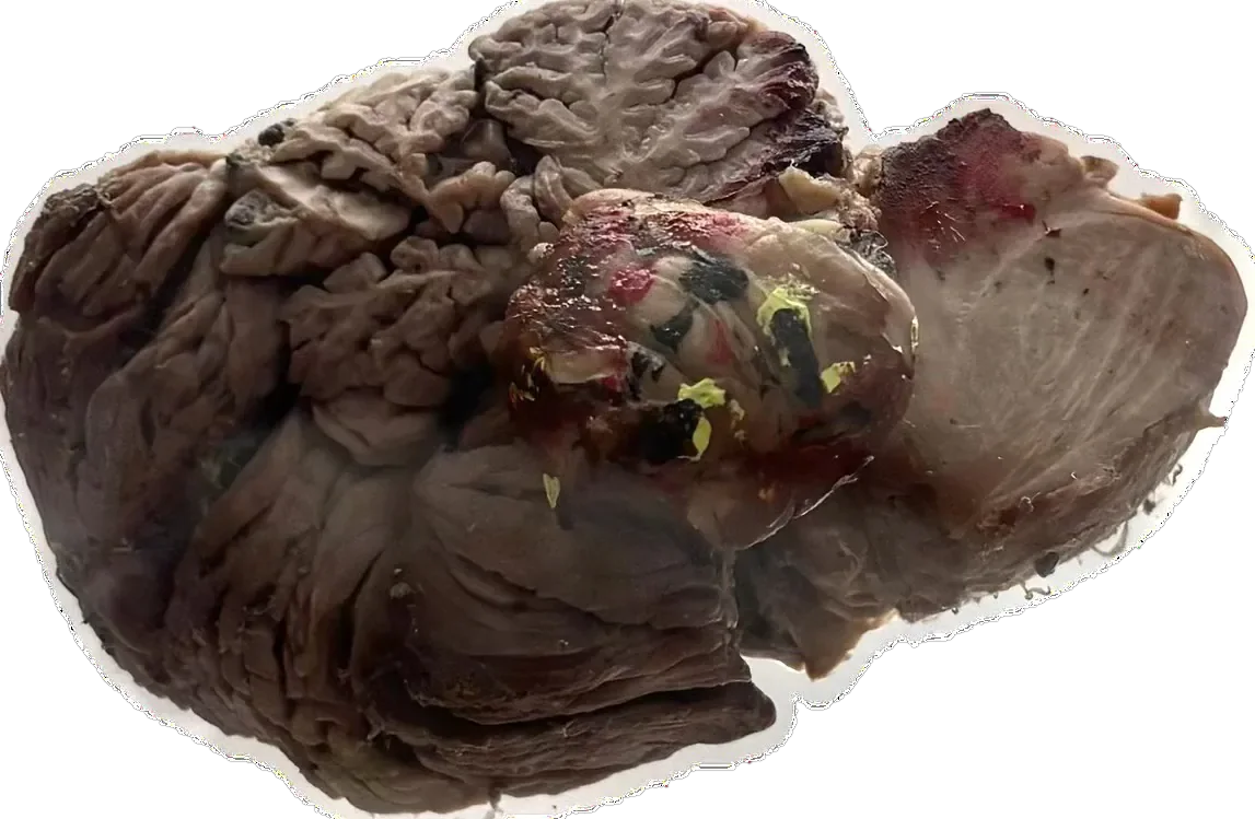 Choroid Plexus tumour - Directly inside fluid spaces of lateral & IV ventricle