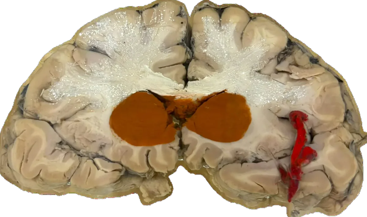 Coronal Section - Thalamus