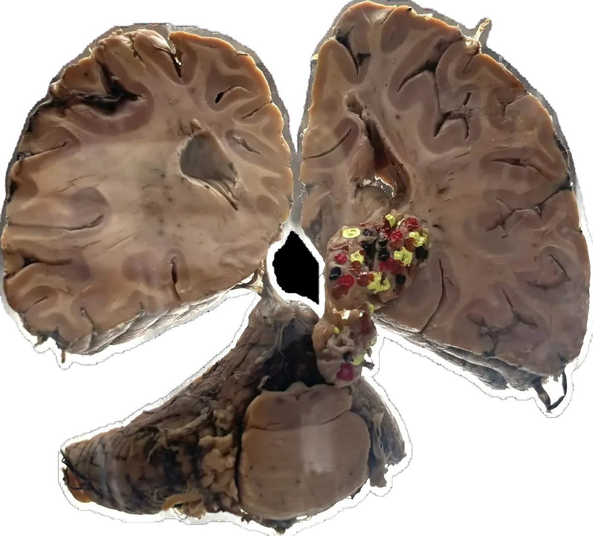 Ependymoma - Involves Linings of lateral ventricles