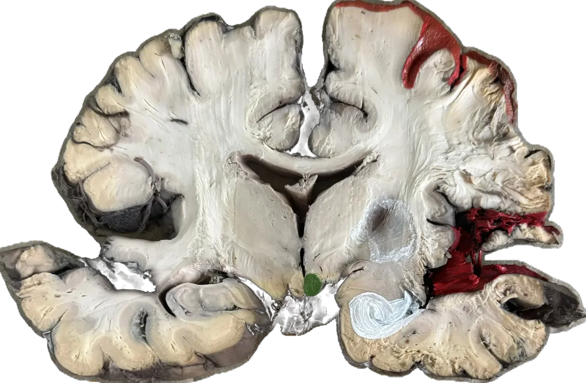 Epileptic brain