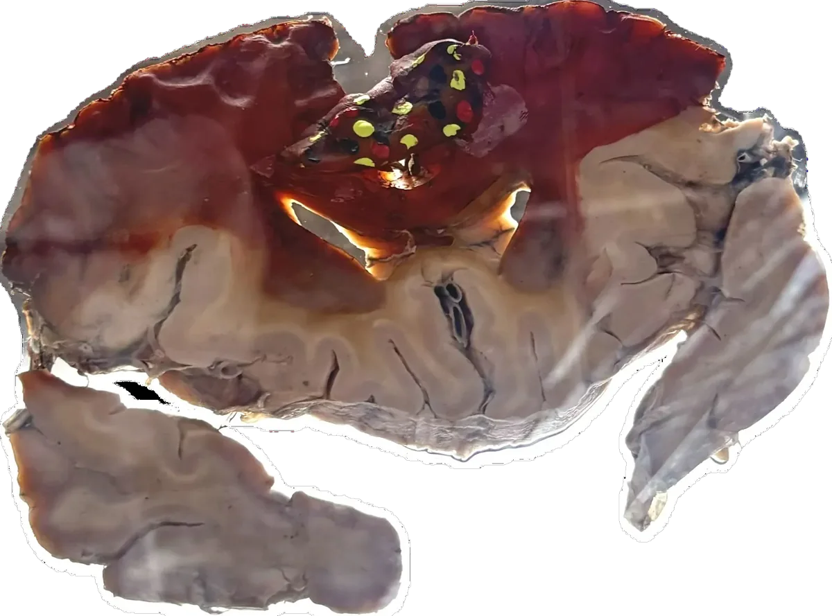 Glioblastoma - Involves Cerebral Cortex, White matter & Midline of Corpus Callosum