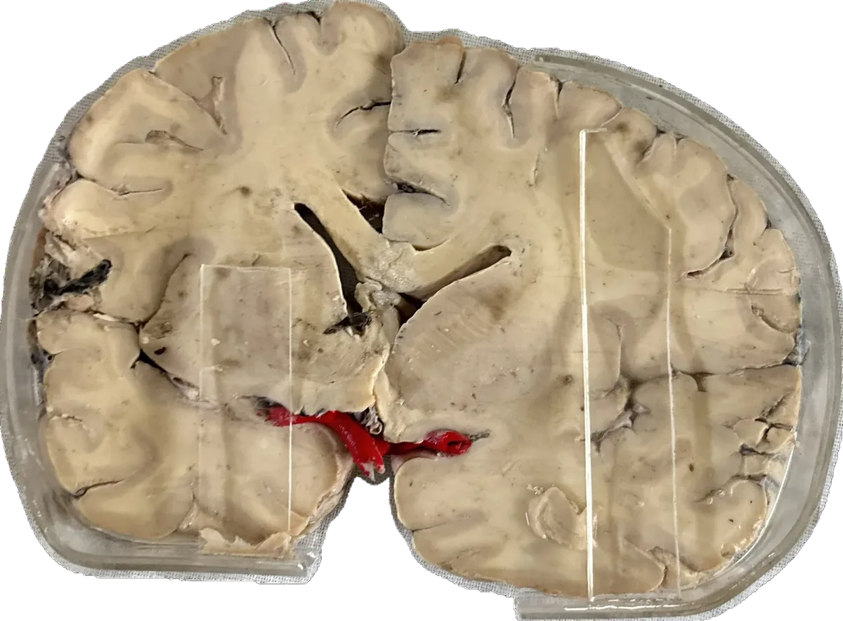 Internal Carotid Artery