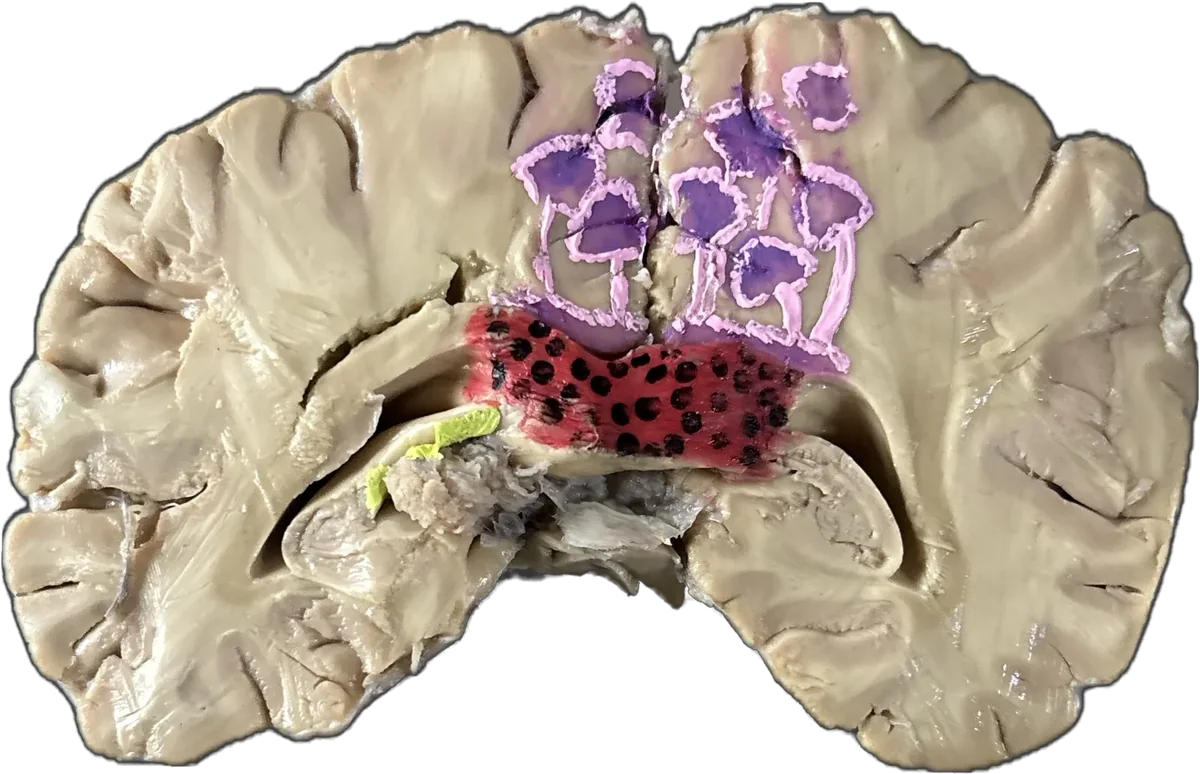 Magic Mushrooms Poisoning