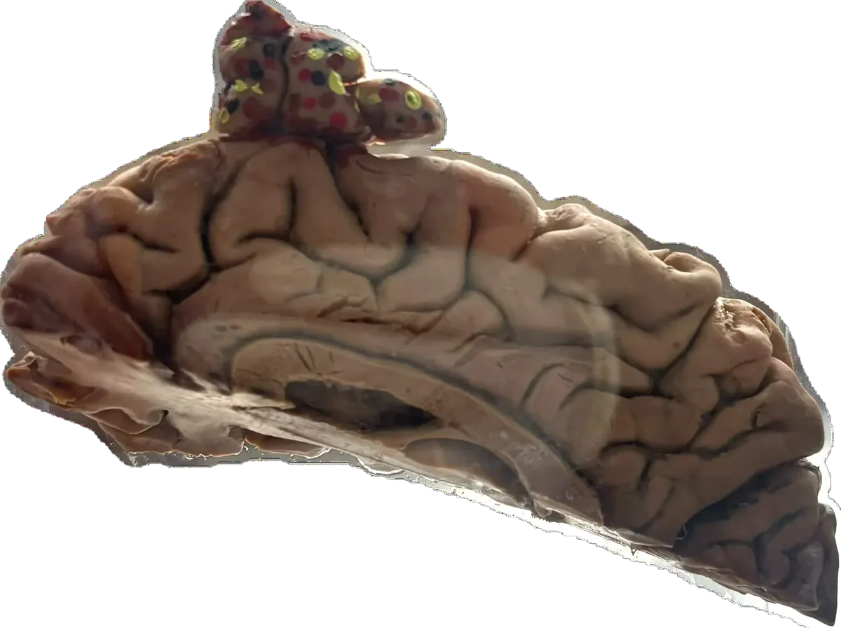 Oligodendroglioma - Involves Frontal & Parietal Lobes