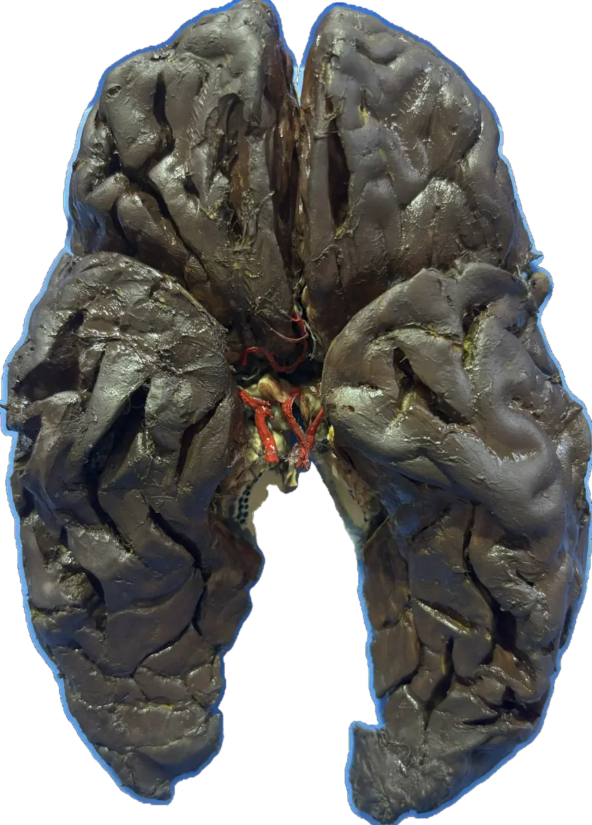 Parkinson's brain