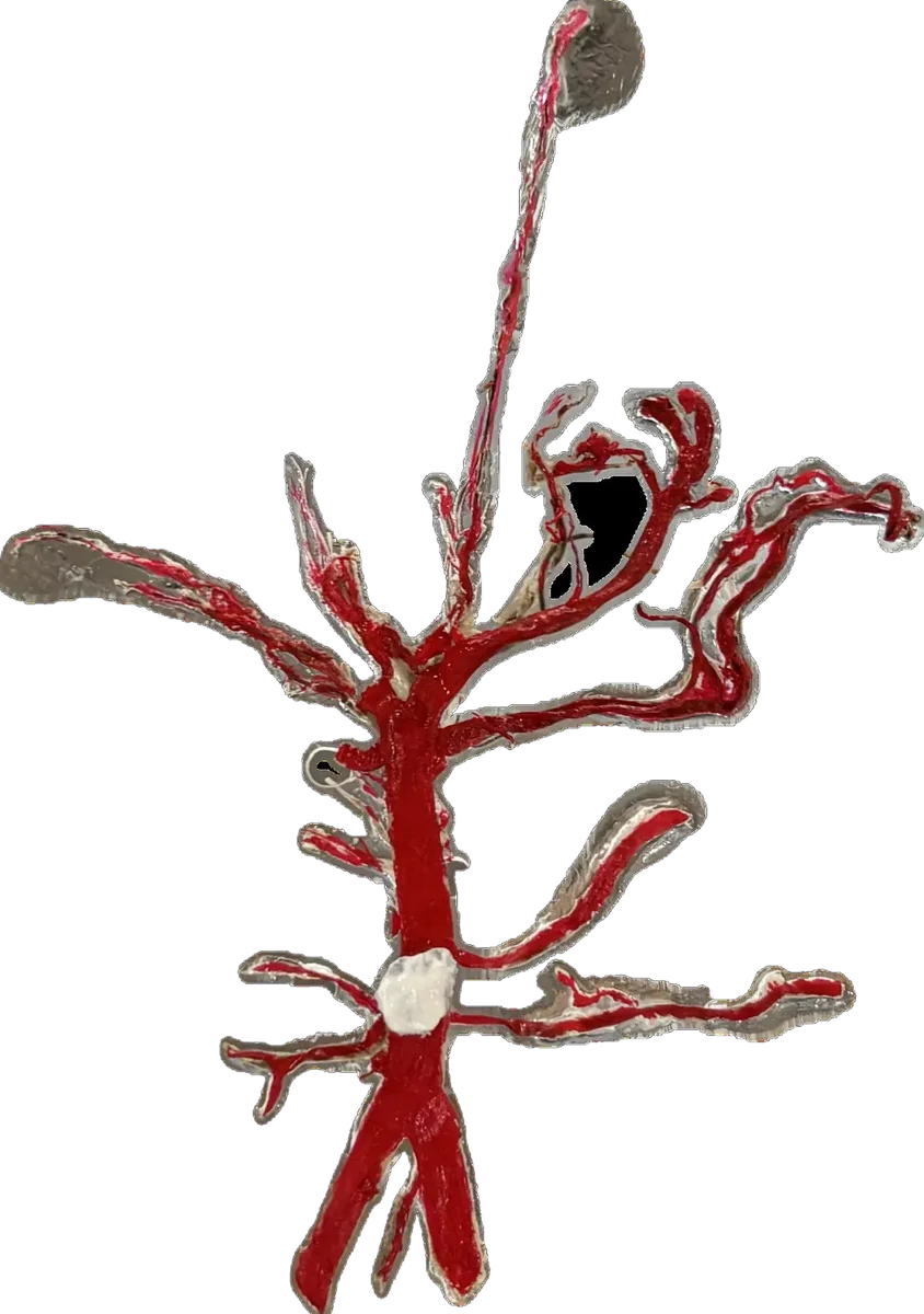 Thrombosis of basilar artery