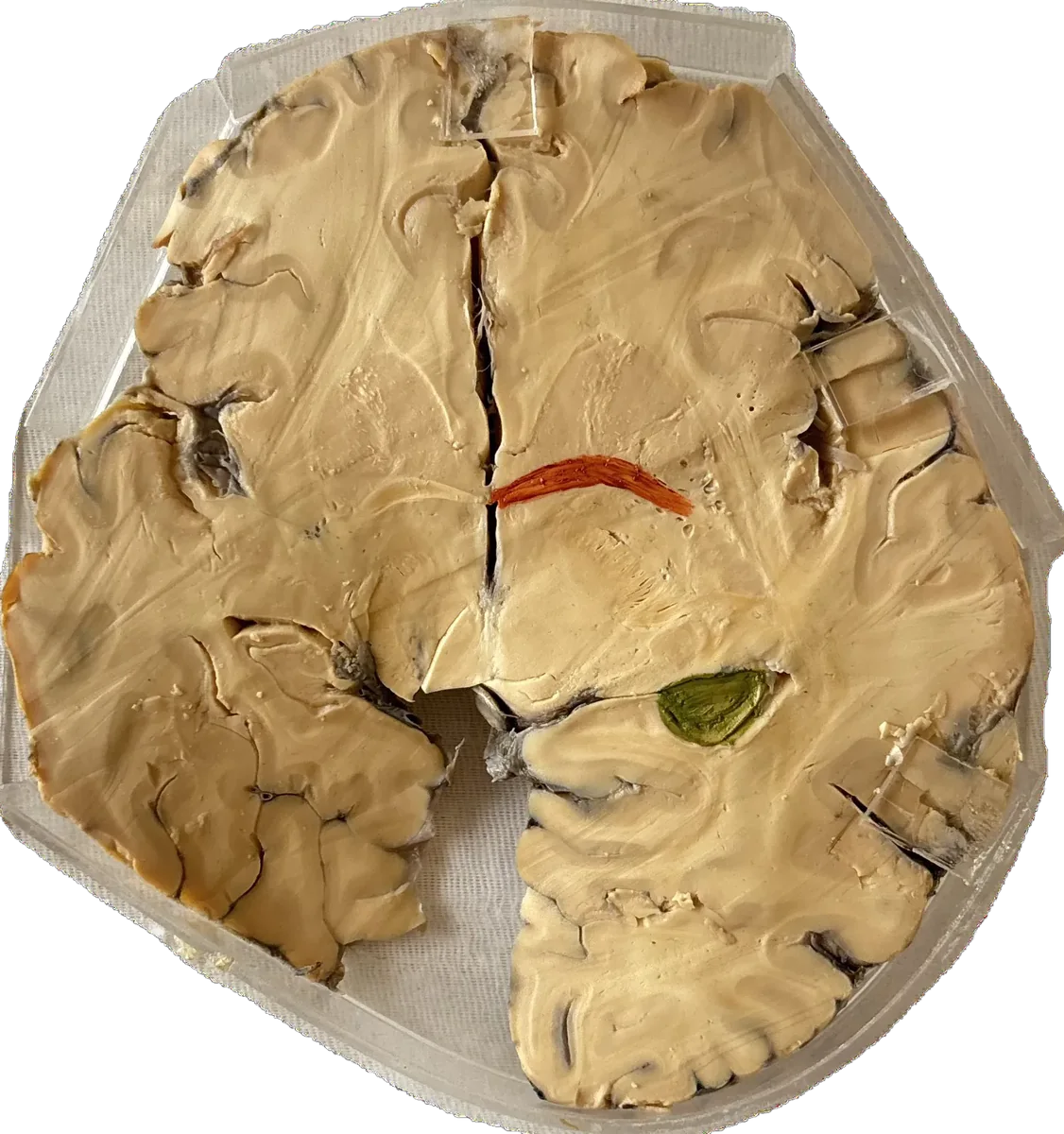 Transverse Section - Anterior Commissural Fibres