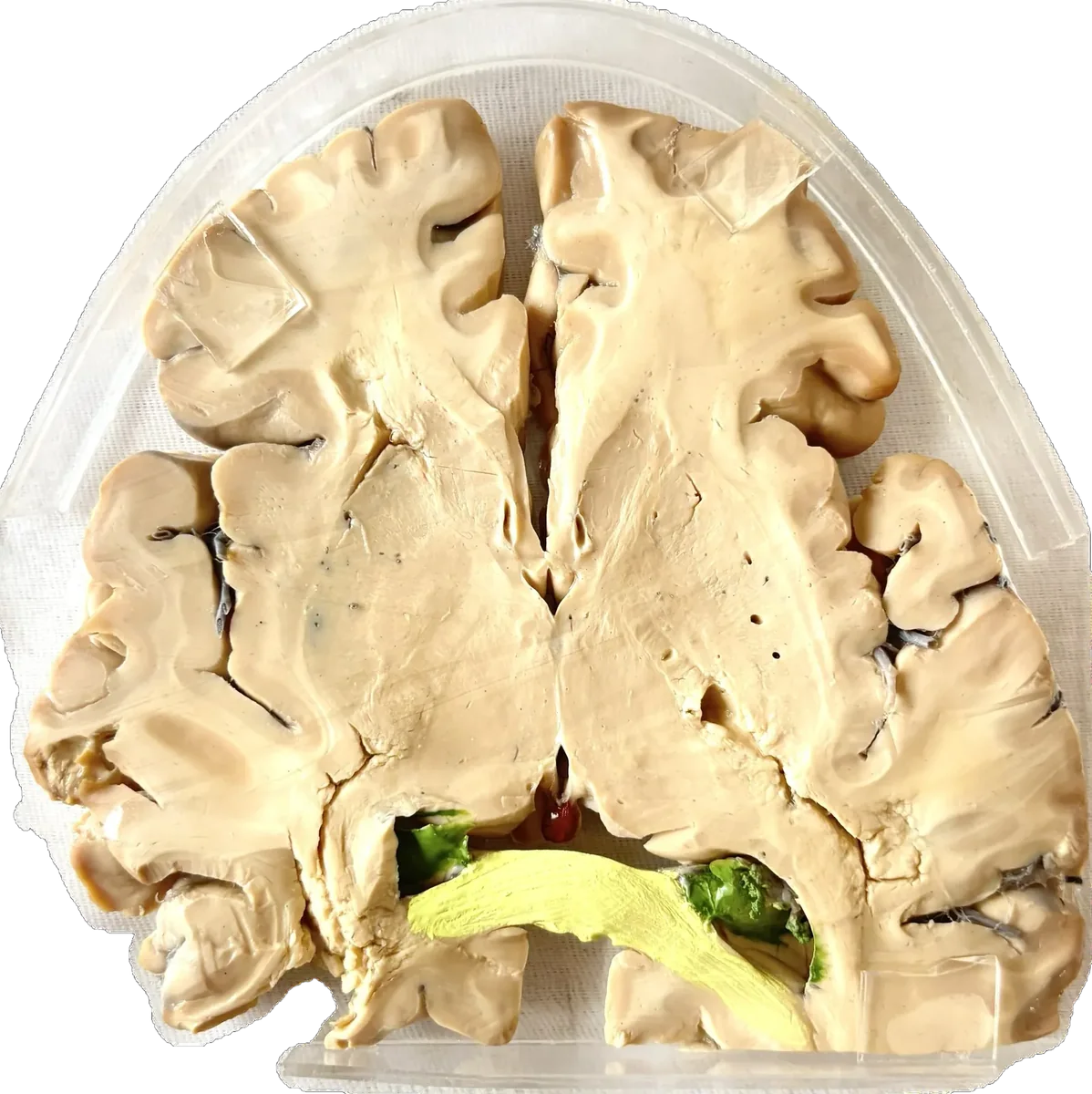 Transverse Section - Pineal Gland & Hippocampus