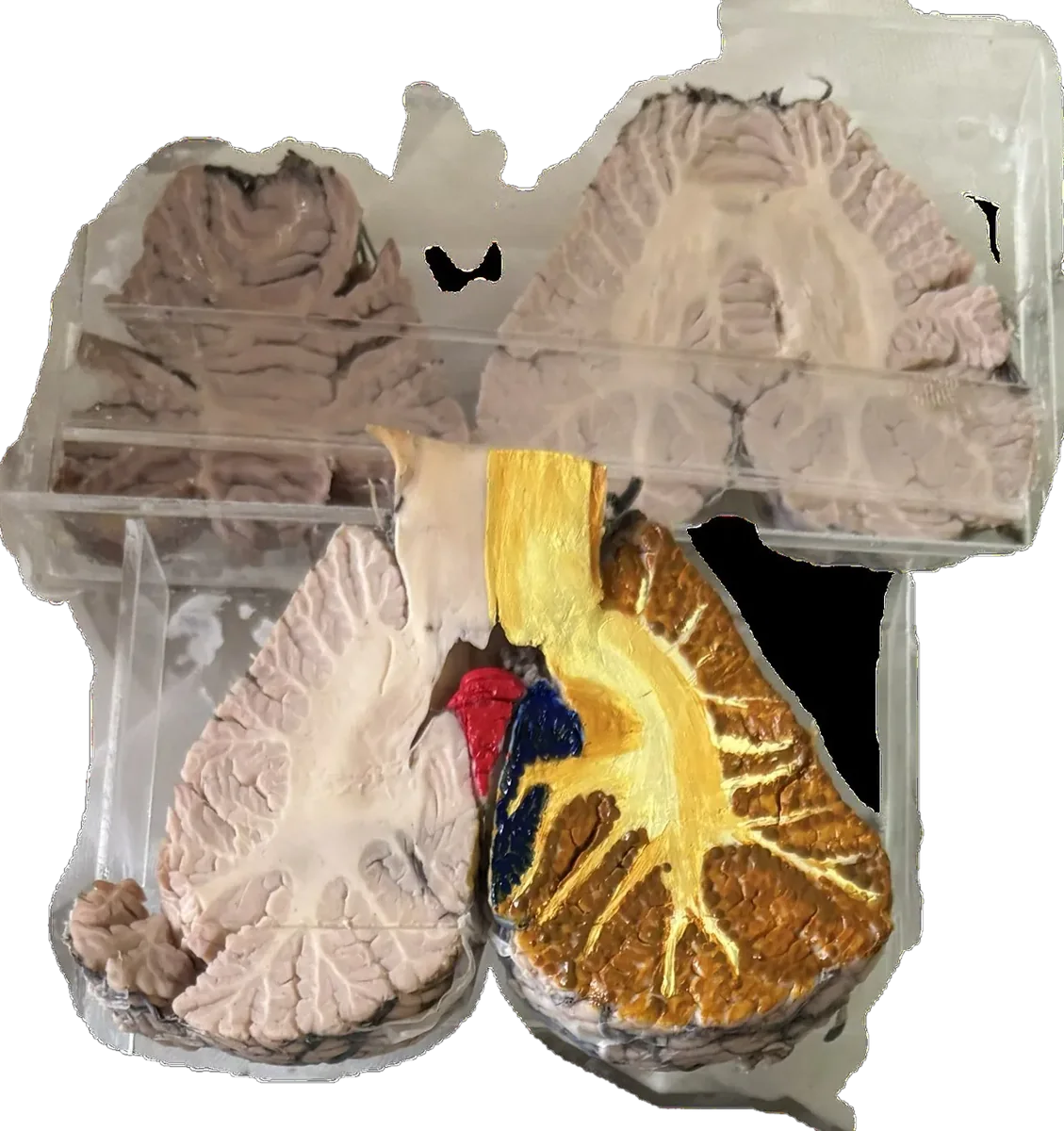 T/S showing dendate nucleus of cerebellum