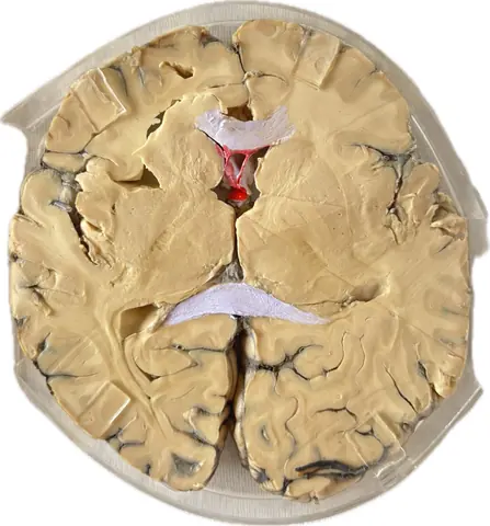 Transverse Section - Corpus Callosum & Septum Pellucidum
